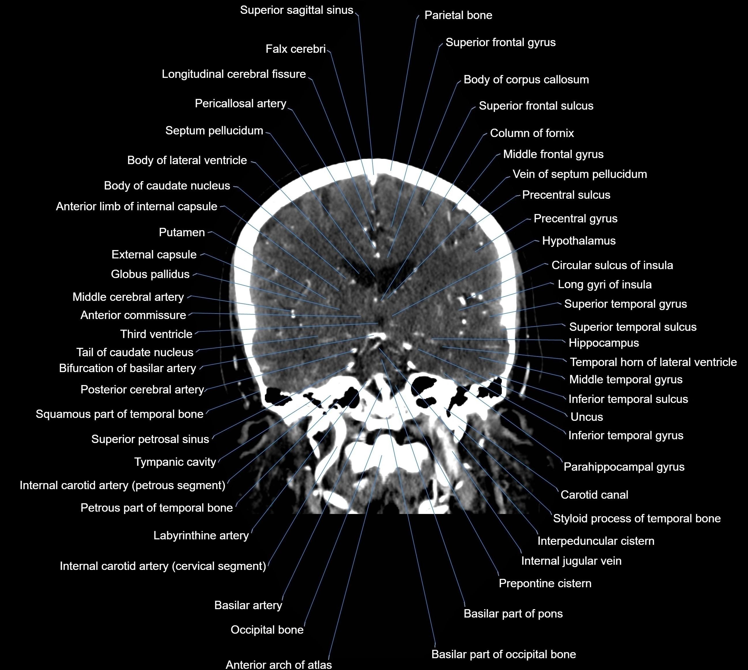 CT Brain coronal cross sectional radiology anatomy image  -img-00001-024.webp